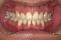 Patient's teeth after orthodontic treatment, front view