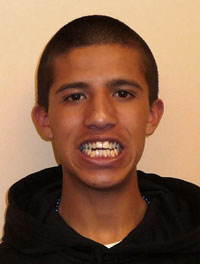 Picture of patient smiling before orthodontic treatment