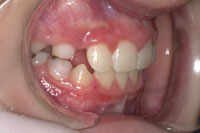 Patient's teeth after orthodontic treatment, side view