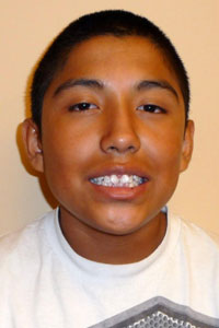 Picture of patient smiling before orthodontic treatment