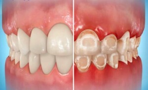 miami-orthodontist-decalcification-with-braces